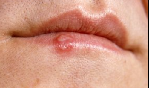 Znanstvenici otkrili zašto se herpes uvijek vraća