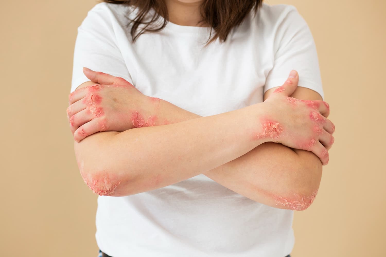 Kako se nositi sa psorijazom?