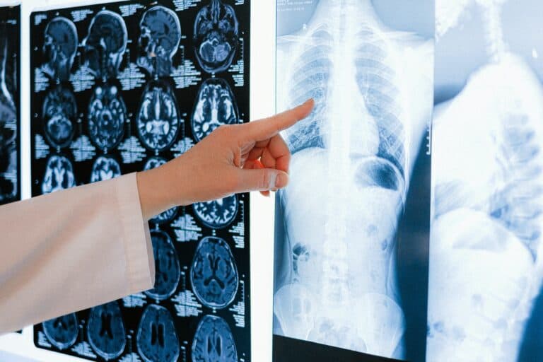  Uzrok, simptomi i liječenje tuberkuloze koja može biti smrtonosna